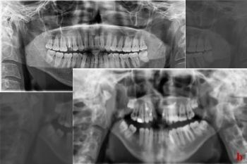 Detecting diseases with artificial intelligence on x-ray film